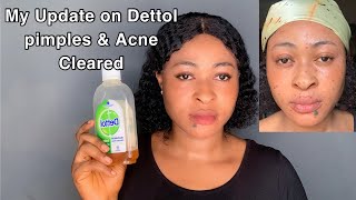 How I cleared my Pimples ampAcne Using Dettol Antiseptic Liquid Full Update [upl. by Aracaj]