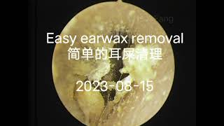 Easy earwax removal（简单的耳屎清理）20230816 [upl. by Daffy]