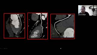 Clase 15  Angiotomografía en la enfermedad coronaria [upl. by Eissen]