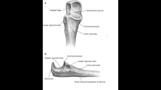 Olecranon Osteotomy Approach [upl. by Sillihp267]