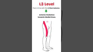 Lumbar Radiculopathy  Sciatica  Clinical Presentation in Patients [upl. by Brice]