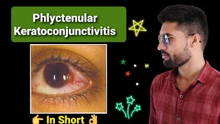 Phlyctenular keratoconjunctivitis lecture opthalmology [upl. by Feinberg]