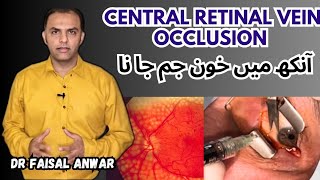 Treatment of Central Retinal Vein Occlusion  Intravitreal Injections 💉 [upl. by Arvy]