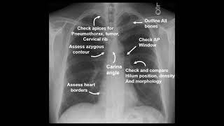 Chest Xray Review Areas in 1 min [upl. by Christye]