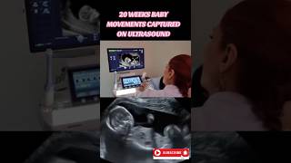 pregnancy 20 weeks baby movements🥰🥰🥰viral trending [upl. by Reemas]