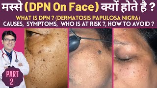 DPN on Face  Dermatosis Papulosa Nigra  What is DPN Removal Treatment In Hindi By Dermatologist [upl. by Ayit]