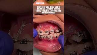 Reality of Dental Braces Treatment that All Patients Should Know  braces dentalbraces shorts [upl. by Ob279]