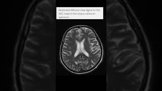 Cytotoxic lesion of corpus callosum MRI ctscanandmri youtubeshorts shortvideoshorts [upl. by Rolyks]