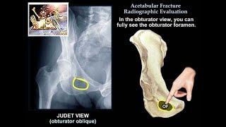 Acetabular Fracture Radiographic Evaluation  Everything You Need To Know  Dr Nabil Ebraheim [upl. by Aehsan]