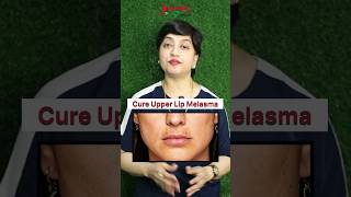 Cure Upper Lip Melasma  Herbal Remedy  Cure For Melasma  Juvena Herbals [upl. by Zoes]