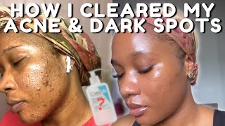 HOW I CLEARED MY ACNE BREAKOUTS AND DARK SPOTS NO TRETINOIN  iJay Amadi [upl. by Diskin478]