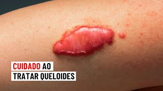 Cuidado ao tratar queloides ⚠ [upl. by Nos]