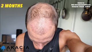 Hair Transplant Growth Timeline  the first 3 months [upl. by Dlopoel978]