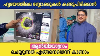 ഹൃദയത്തിലെ ബ്ലോക്കുകൾ കണ്ടുപിടിക്കാൻ ആൻജിയോഗ്രാം ചെയ്യുന്നത് കാണാം  Angiogram Malayalam video [upl. by Irmgard997]