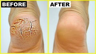 फटी एड़ियों से छुटकारा पाने के 5 आसान घरेलु उपाय  Cracked Heels Home Remedy [upl. by Lal]