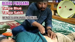 OPRASI TANPA JAIT TANPA SAKIT MENGELUARKAN BATU GINJAL TANPA BIUS TANPA SAKIT [upl. by Itsyrk547]