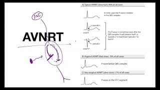 Approach to narrow QRS tachycardia ll Advance level llinicet neetpg neetss2024 iniss [upl. by Pia]