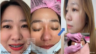 Non surgical Hiko Nose Thread Lift procedure and healing process [upl. by Ardnuhsed]