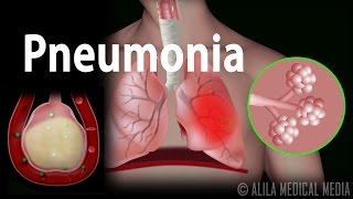 Pneumonia Animation [upl. by Roux427]