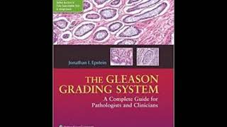 The Gleason Grading System A Complete Guide for Pathologist and Clinicians [upl. by Marjy]