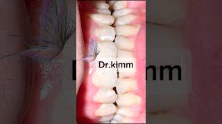 scaling teeth  scaling [upl. by Llehcam]