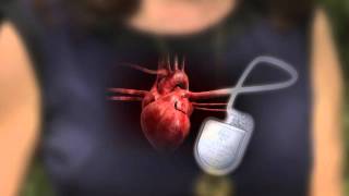 DefibrillatorPacemaker Whats the Difference [upl. by Suolekcin]