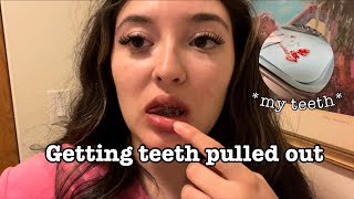 GETTING 4 TEETH PULLED OUT😭I cried [upl. by Blight539]