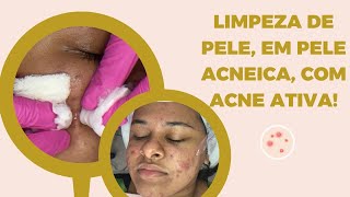 Limpeza de pele profissional em pele acneica com acne ativa [upl. by Eidlog]