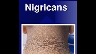 Acanthosis Nigricans [upl. by Acirderf]