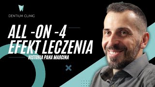 LECZENIE ALLON4  ZOBACZ JEGO EFEKT U PANA MARCINA [upl. by Crescen]