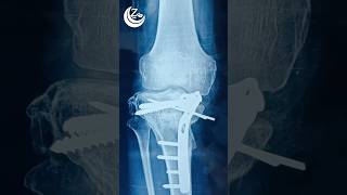 Intraarticular osteotomy [upl. by Gable478]