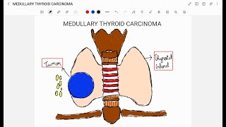 MEDULLARY THYROID CARCINOMA [upl. by Petras]