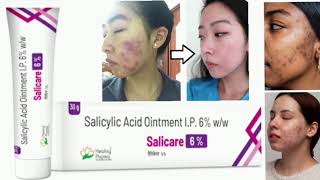 Salicare 6 Ointment Cream Salicylic Acid Ointment IP 6 ww [upl. by Ruddy]