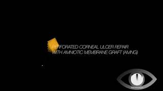 Corneal Perforation Repair  Amniotic Membrane Graft [upl. by Weyermann447]