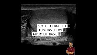 Testicular microlithiasis Should we worry [upl. by Sherburne]