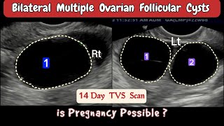 TVS Ultrasound  Bilateral multiple Ovarian Follicular Cysts [upl. by Yezdnil]