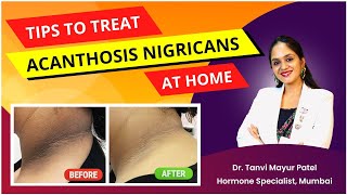 Dark Patch Acanthosis Nigricans Treatment by Dr Tanvi Mayur Patel [upl. by Gargan]