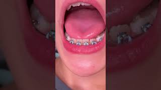 What is Phase One orthodontic treatment  Tooth Time Family Dentistry New Braunfels [upl. by Aynatal]