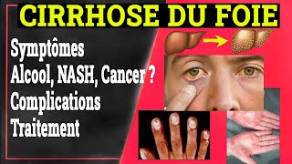 Cirrhose du Foie Clinique Complications Traitement  Gastrologie Medicale [upl. by Iren]