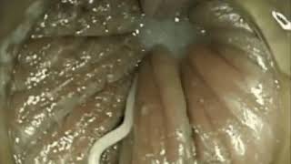 Enterobius vermicularisPinworm Infection [upl. by Eseila]