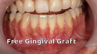 Free Gingival Graft [upl. by Tristas]