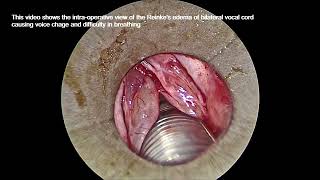 Reinkes edema surgical videos [upl. by Enneyehs]