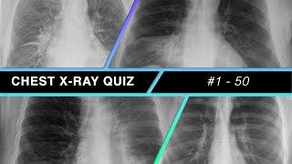 Chest Xray Quiz 1  50 [upl. by Leacock]