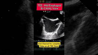 Transesophageal Echocardiogram  BiCaval View echocardiography [upl. by Nihs374]