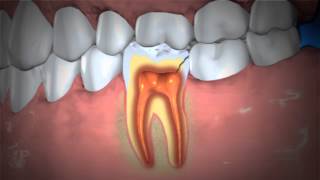 Treatment of Abscessed Teeth [upl. by Galan17]