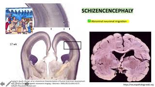 Porencephaly versus Schizencephaly 22 [upl. by Htrowslle342]