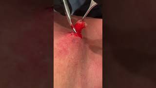 NECK CYST [upl. by Dlopoel]