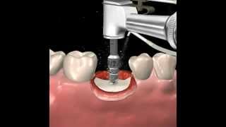 Step by step dental implant surgery Gary R OBrien DDS [upl. by Mahgirb]