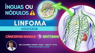 🟢 Linfoma de Hodgkin O que é ⚠️ Cuidado com Ínguas e Caroços [upl. by Rehotsirk]