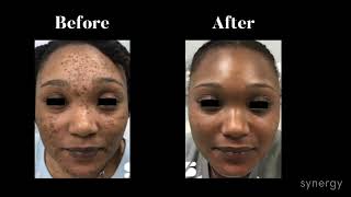 Two Faced Cyspera for Pigmentation Skincare on Two Types of Skin with Medical Aesthetician Emily T [upl. by Daggna]